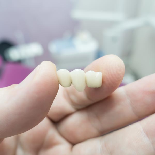 partial tooth bridge