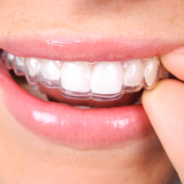 invisalign braces